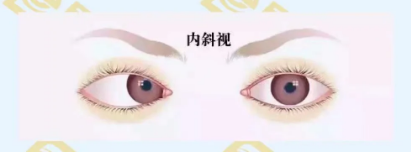 什么是調(diào)節(jié)性內(nèi)斜視？