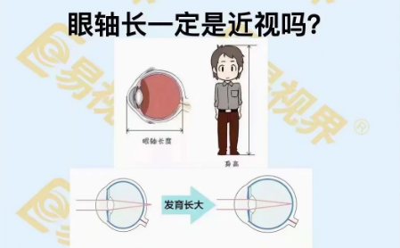 眼軸長(zhǎng)一定是近視嗎？