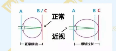 哪個(gè)年齡近視度數(shù)最容易增長(zhǎng)？