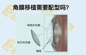 角膜移植需要配型嗎?